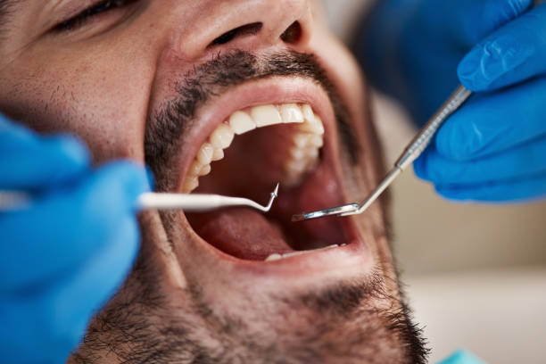 Best Emergency Wisdom Teeth Removal in Edmond, OK