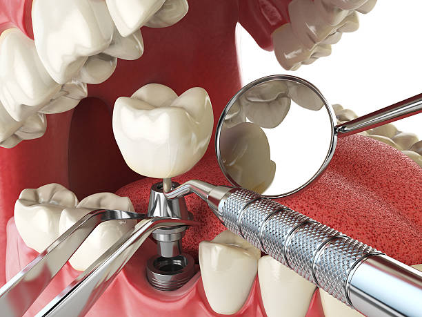 Best Urgent Care for Lost Fillings or Crowns in Edmond, OK